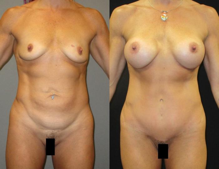 Before & After Mommy Makeover Case 87 View 1 View in Savannah, GA