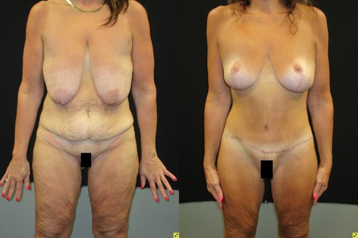 Before & After Mommy Makeover Case 97 View 1 View in Savannah, GA