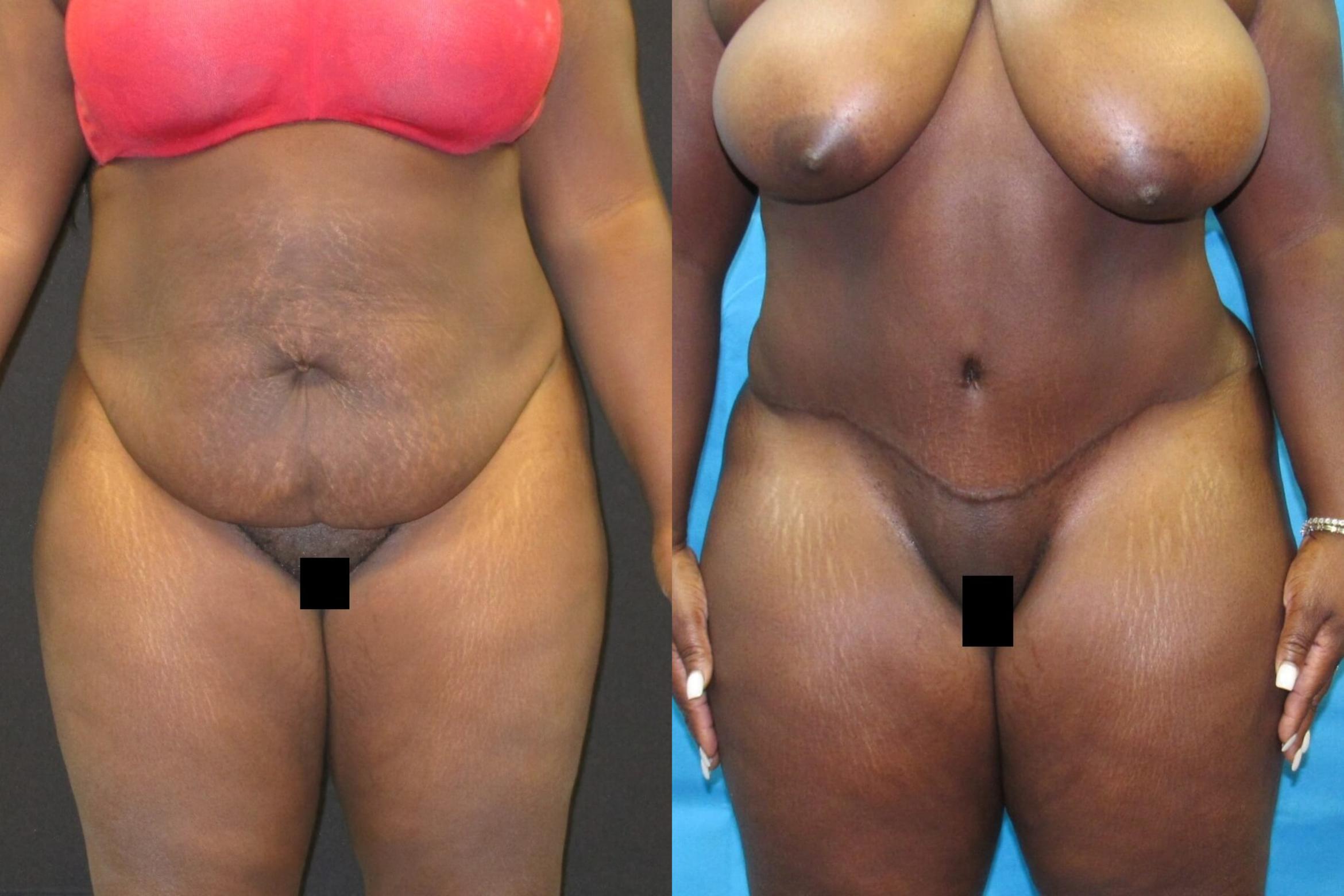 Before & After Tummy Tuck Case 100 View 1 View in Savannah, GA