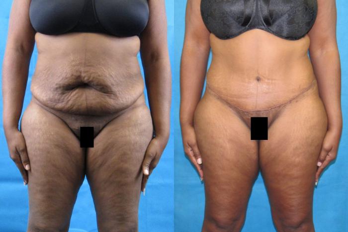 Before & After Tummy Tuck Case 105 View 1 View in Savannah, GA