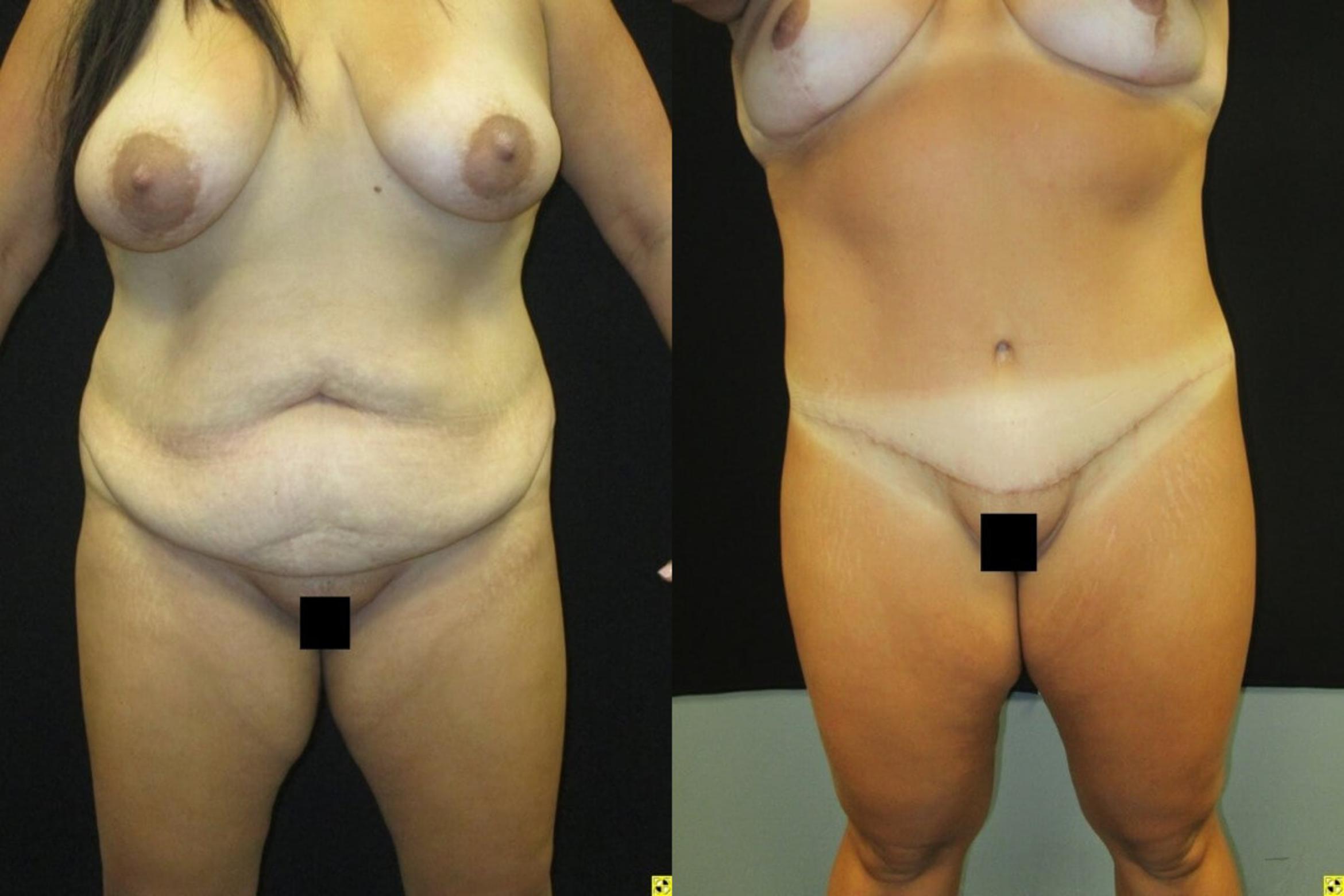 Before & After Tummy Tuck Case 106 View 1 View in Savannah, GA