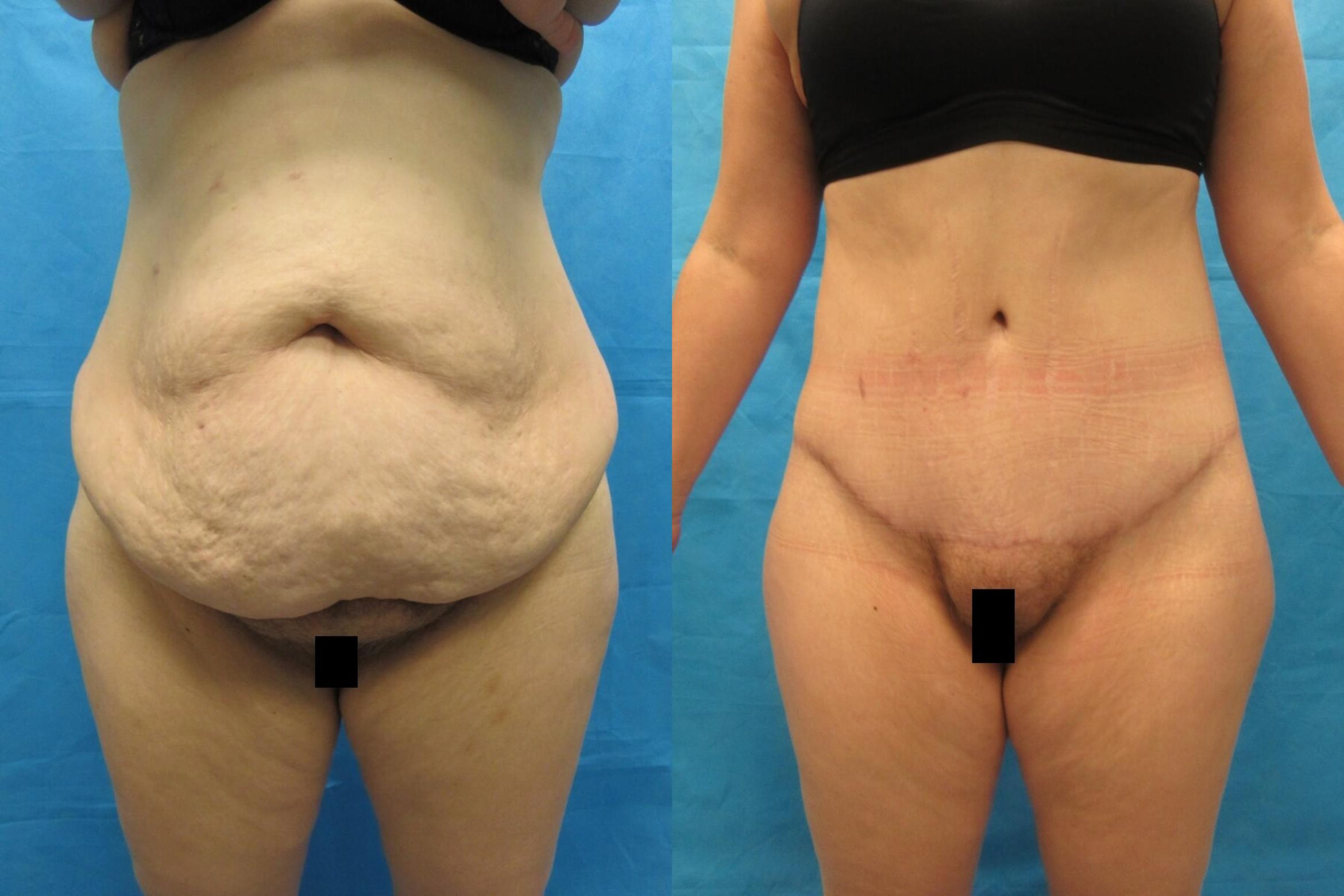 Before & After Tummy Tuck Case 108 View 1 View in Savannah, GA