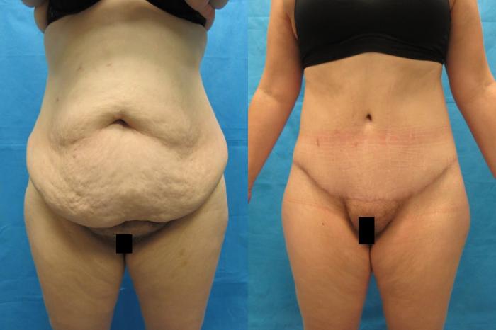 Before & After Tummy Tuck Case 108 View 1 View in Savannah, GA
