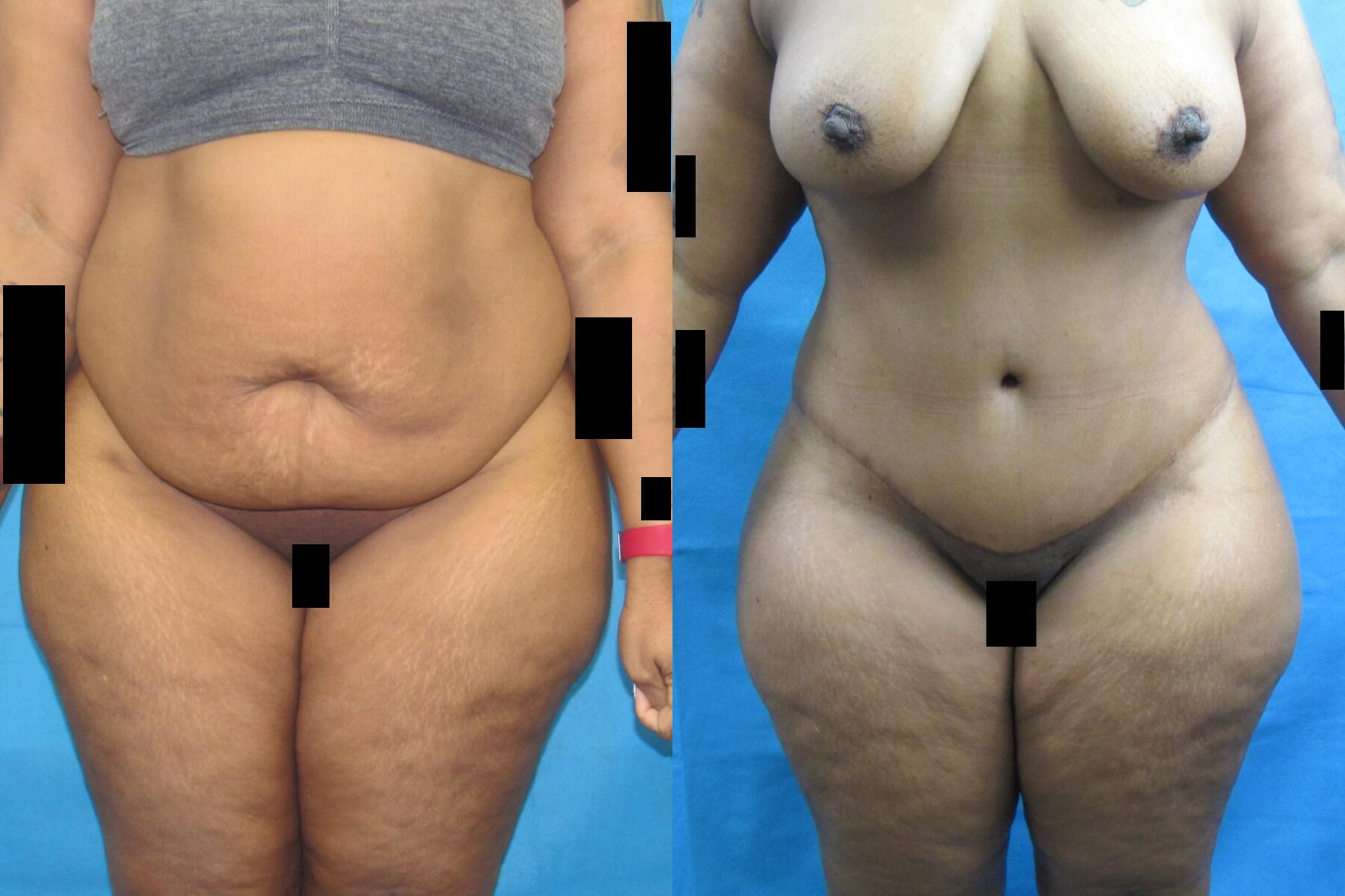 Before & After Tummy Tuck Case 109 View 1 View in Savannah, GA