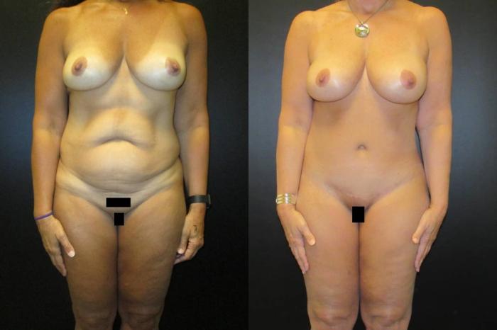 Before & After Tummy Tuck Case 110 View 1 View in Savannah, GA