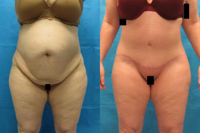 Before & After Tummy Tuck Case 112 View 1 View in Savannah, GA