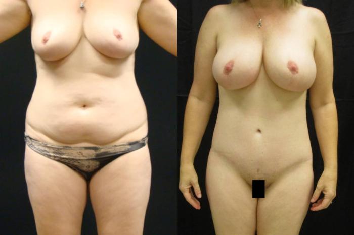 Before & After Tummy Tuck Case 113 View 1 View in Savannah, GA