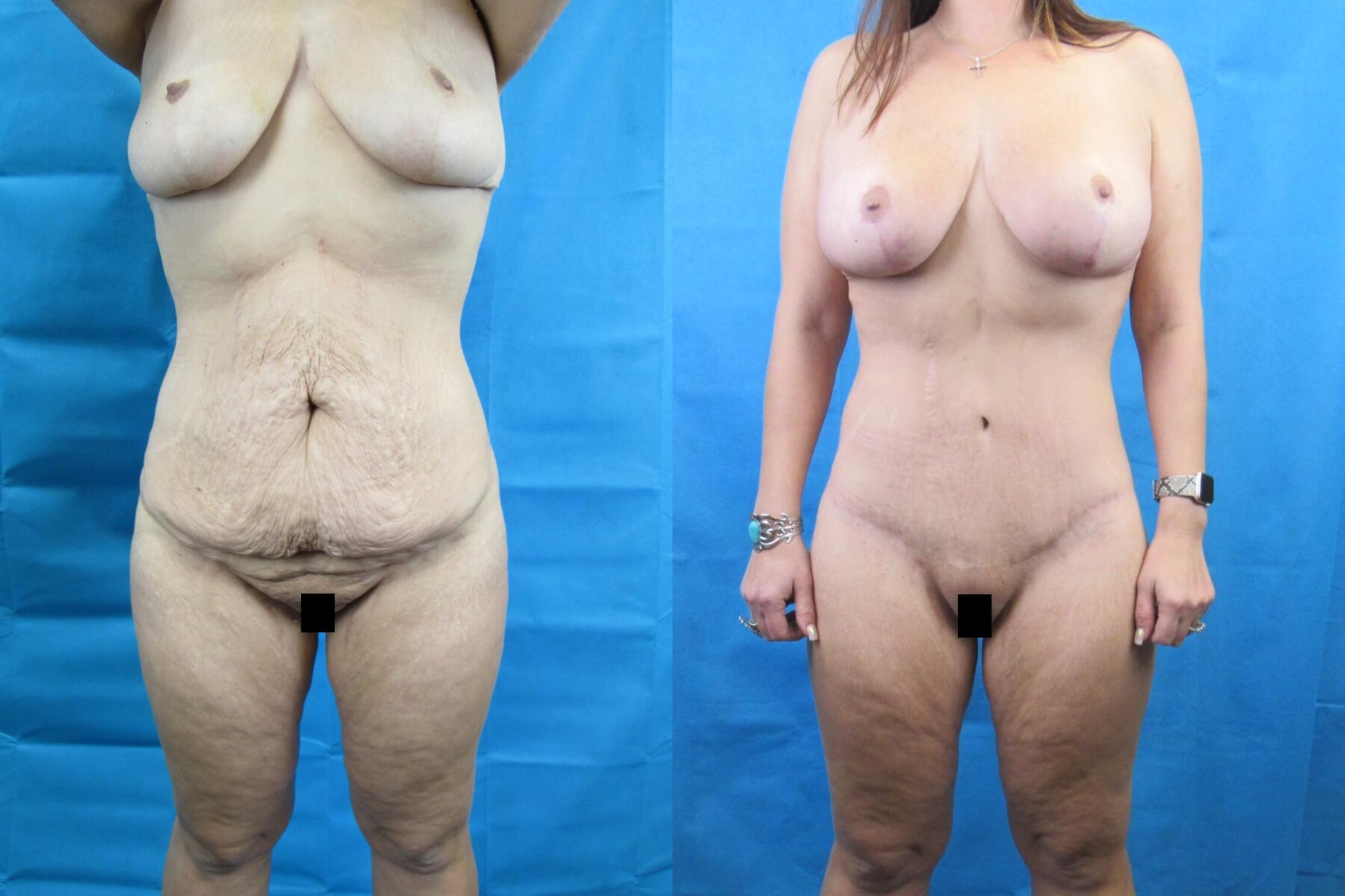 Before & After Tummy Tuck Case 114 View 1 View in Savannah, GA