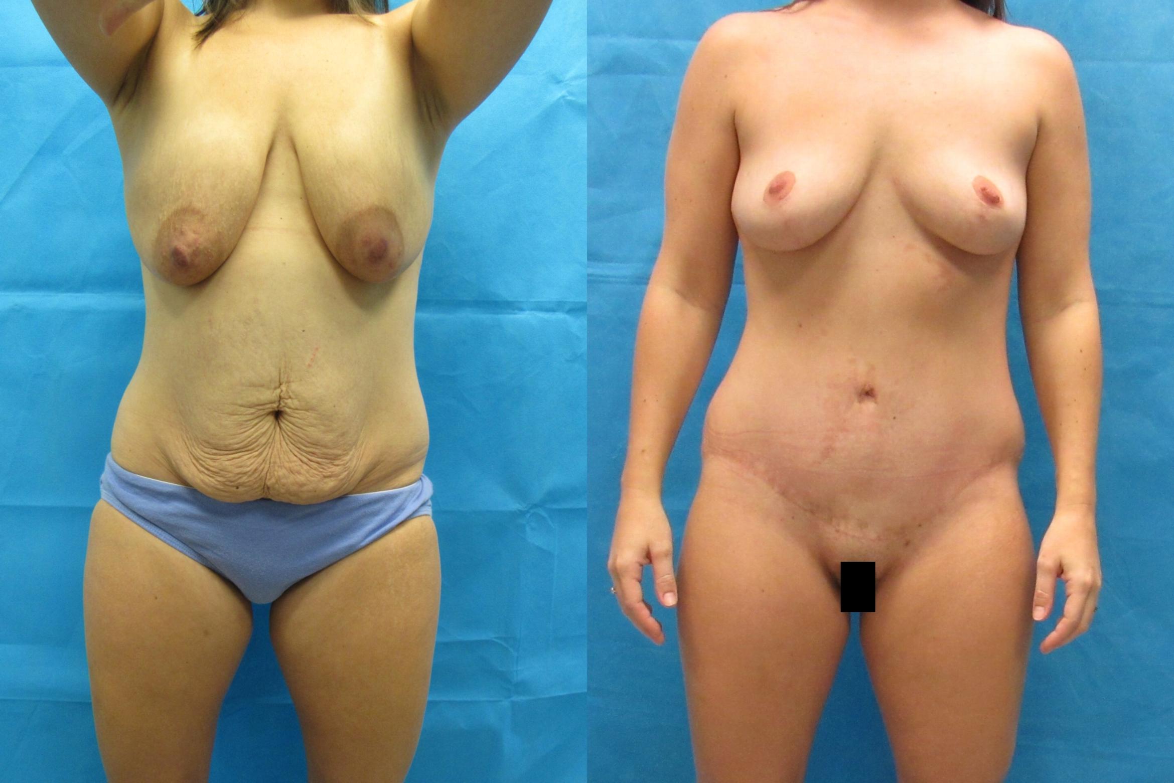 Before & After Tummy Tuck Case 117 View 1 View in Savannah, GA