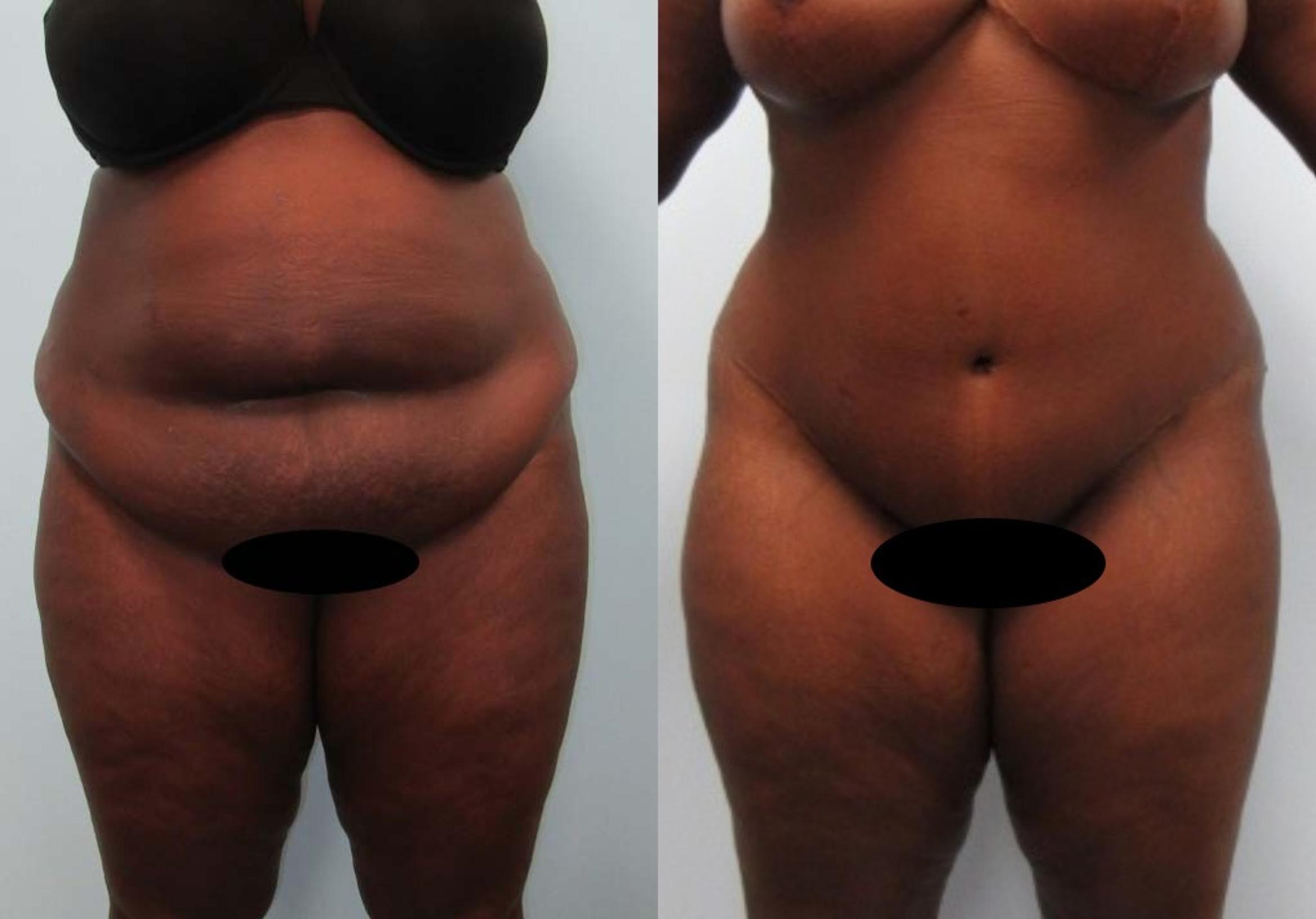 Before & After Tummy Tuck Case 120 View 1 View in Savannah, GA