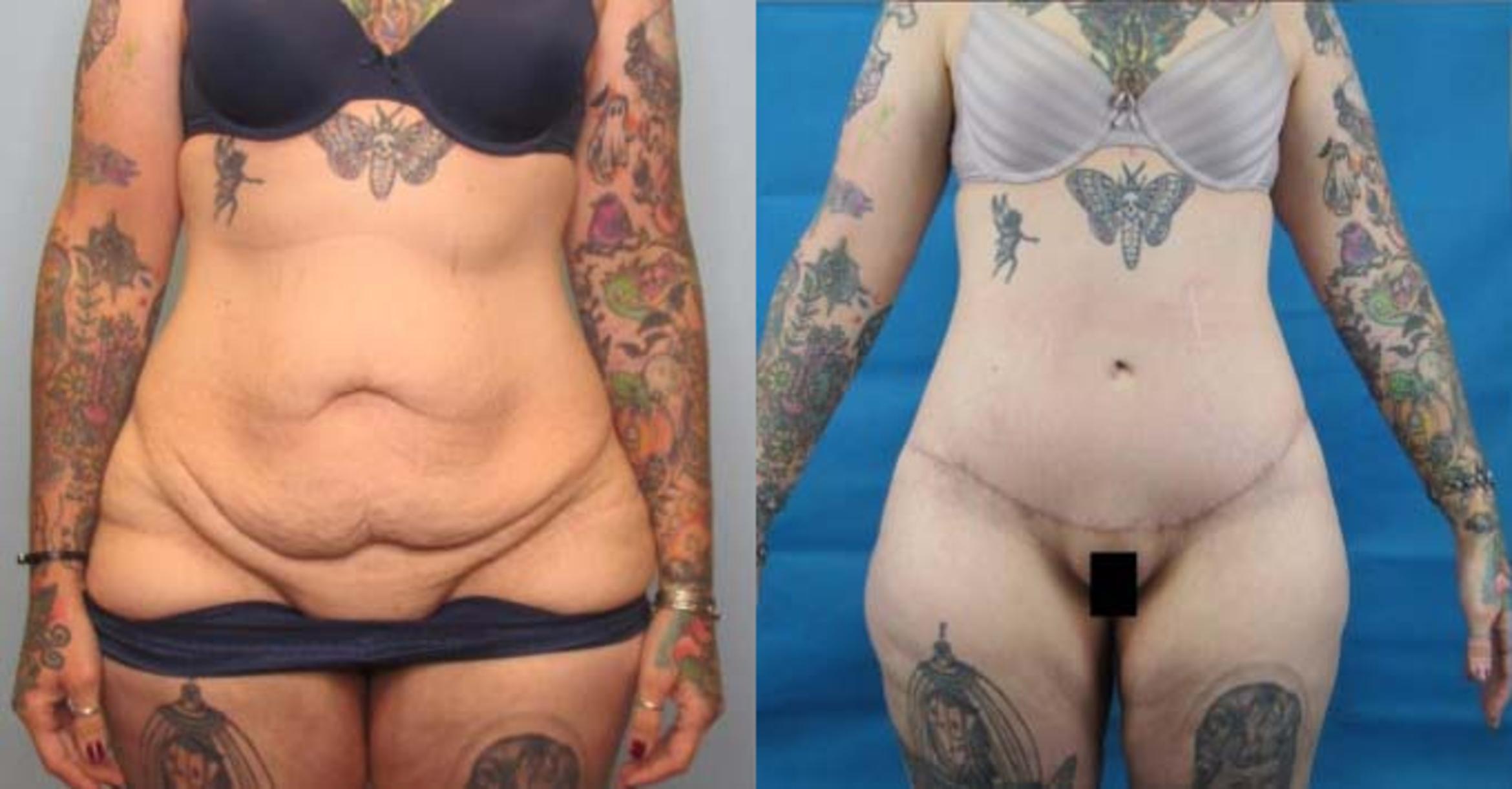 Before & After Tummy Tuck Case 122 View 1 View in Savannah, GA