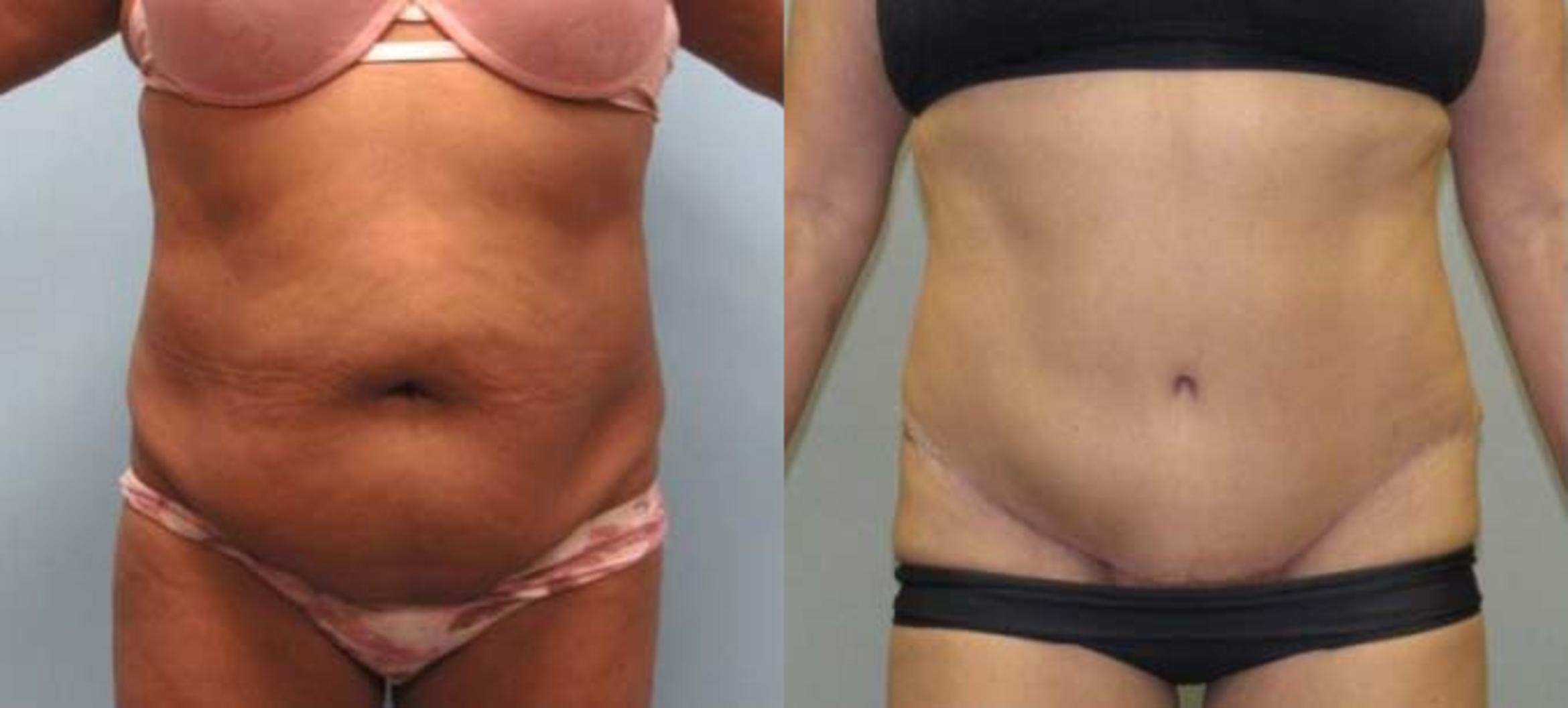 Before & After Tummy Tuck Case 124 View 1 View in Savannah, GA