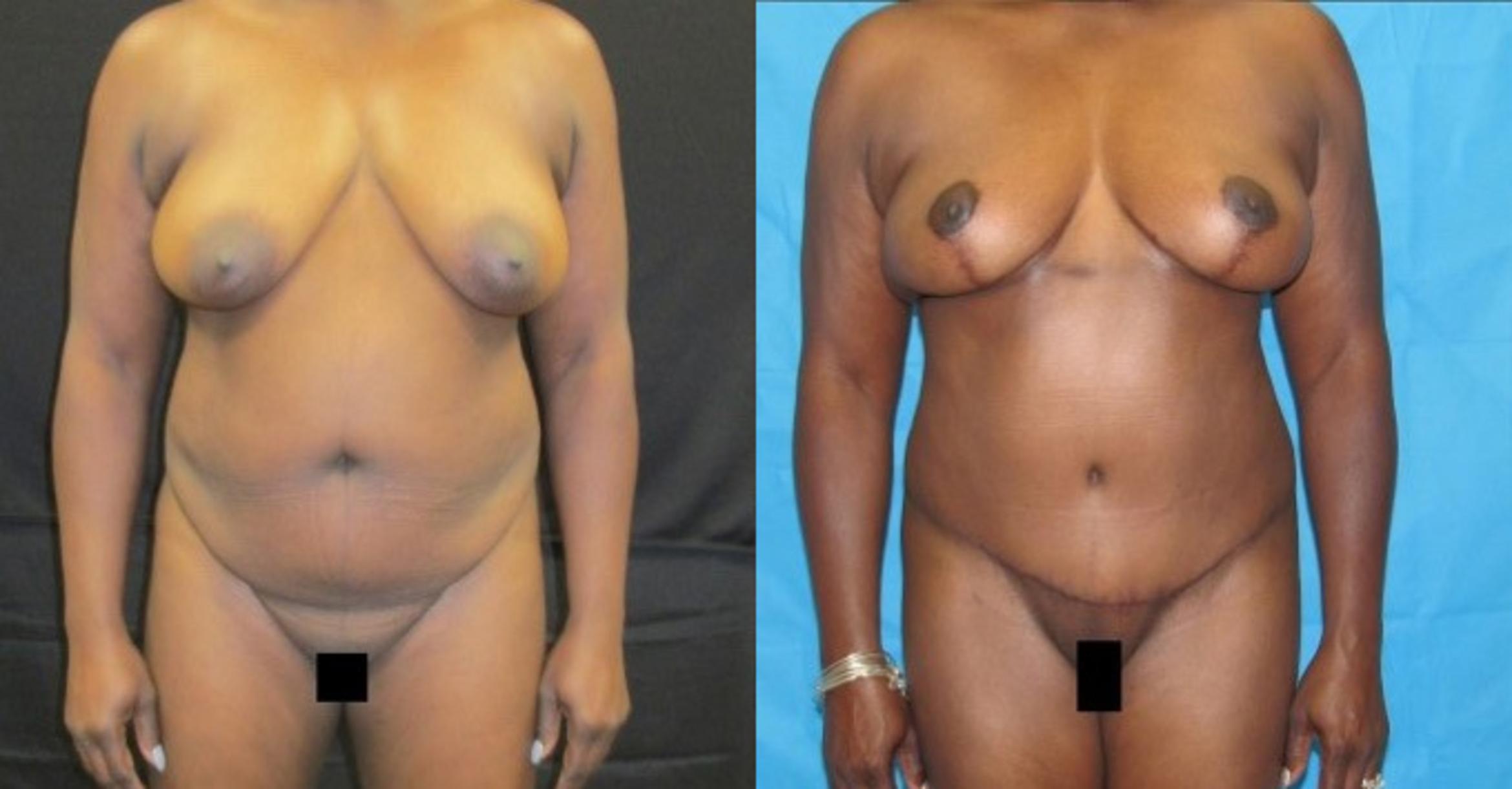 Before & After Tummy Tuck Case 125 View 1 View in Savannah, GA