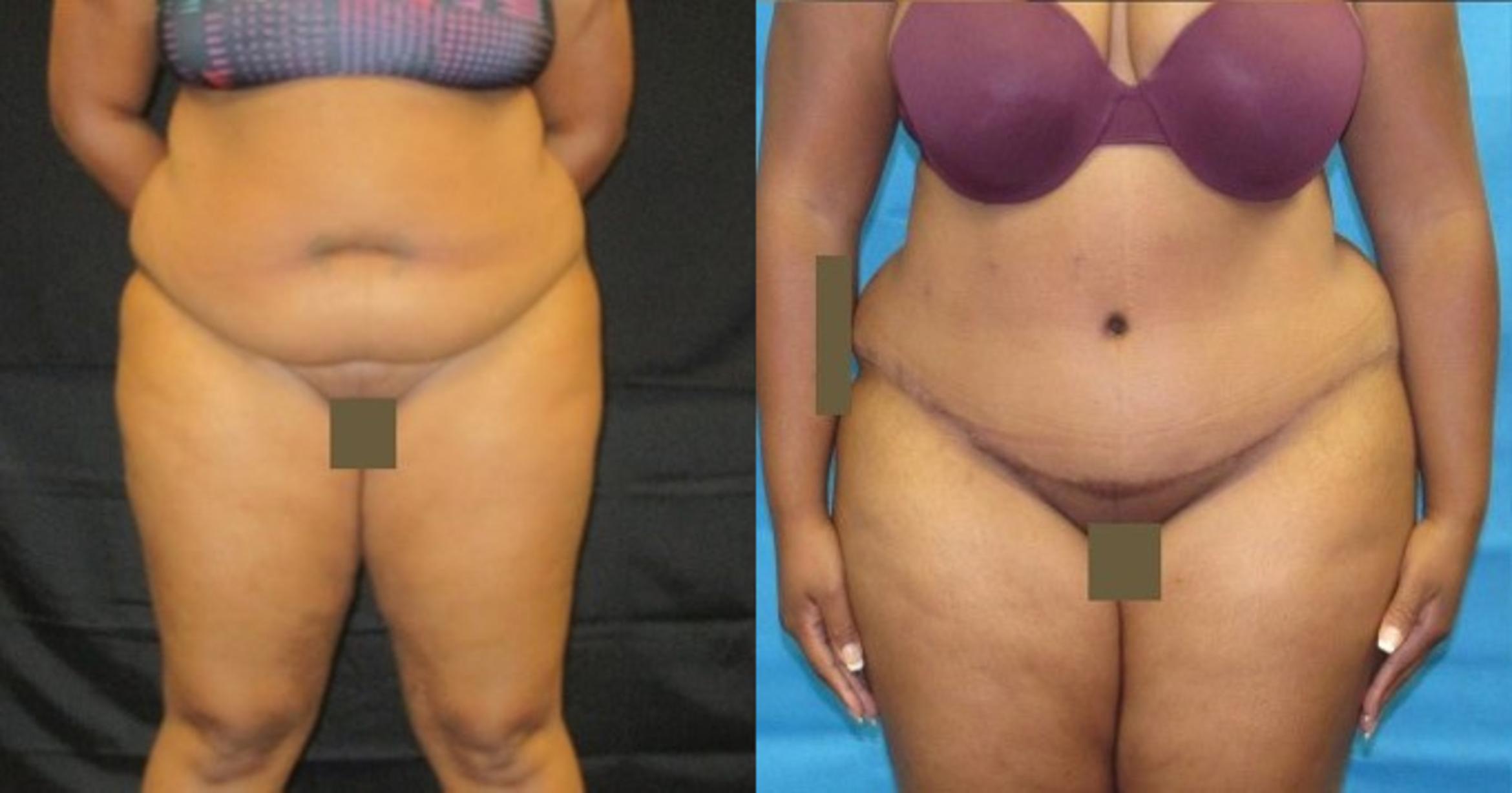 Before & After Tummy Tuck Case 126 View 1 View in Savannah, GA