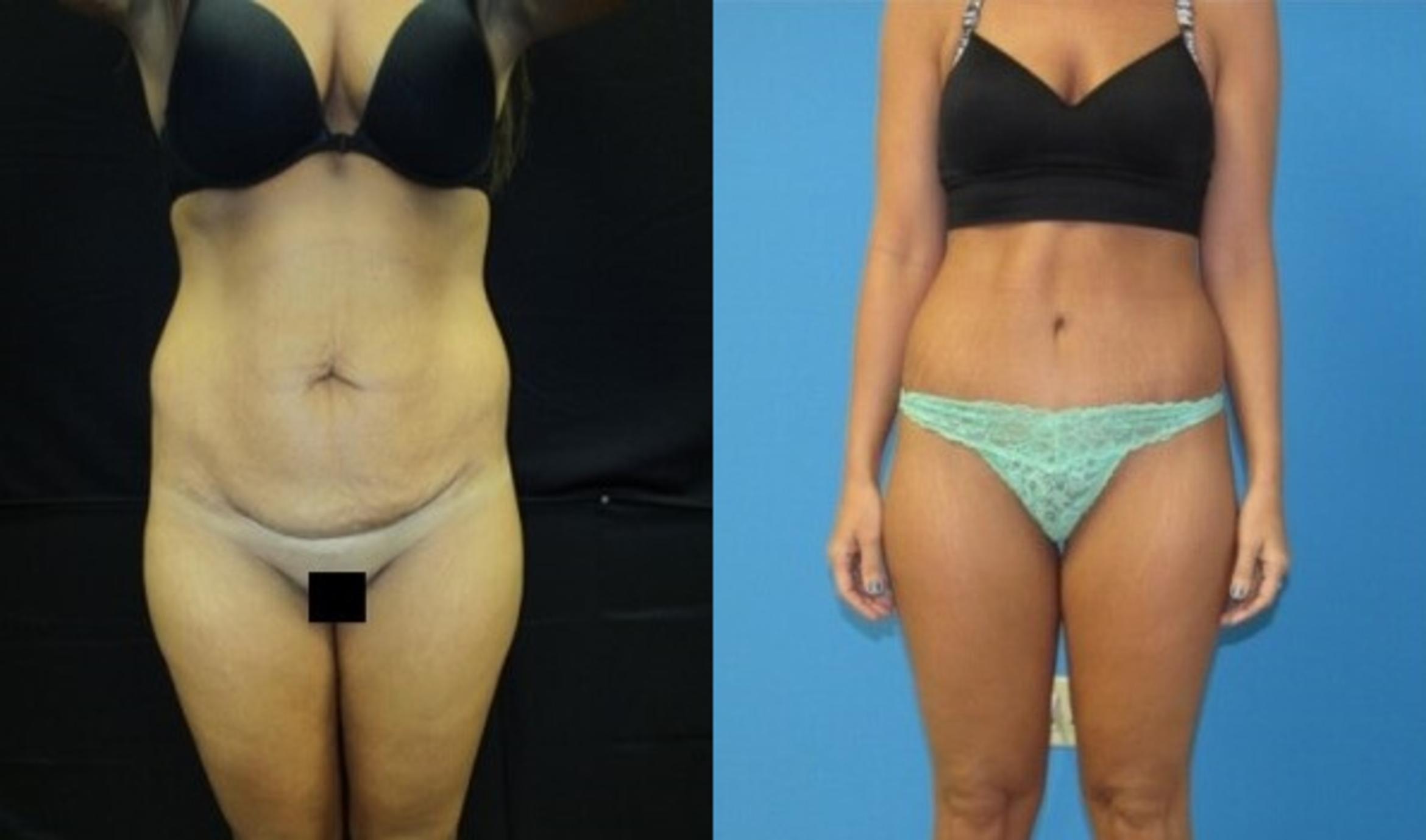 Before & After Tummy Tuck Case 127 View 1 View in Savannah, GA