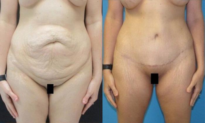 Before & After Tummy Tuck Case 128 View 1 View in Savannah, GA