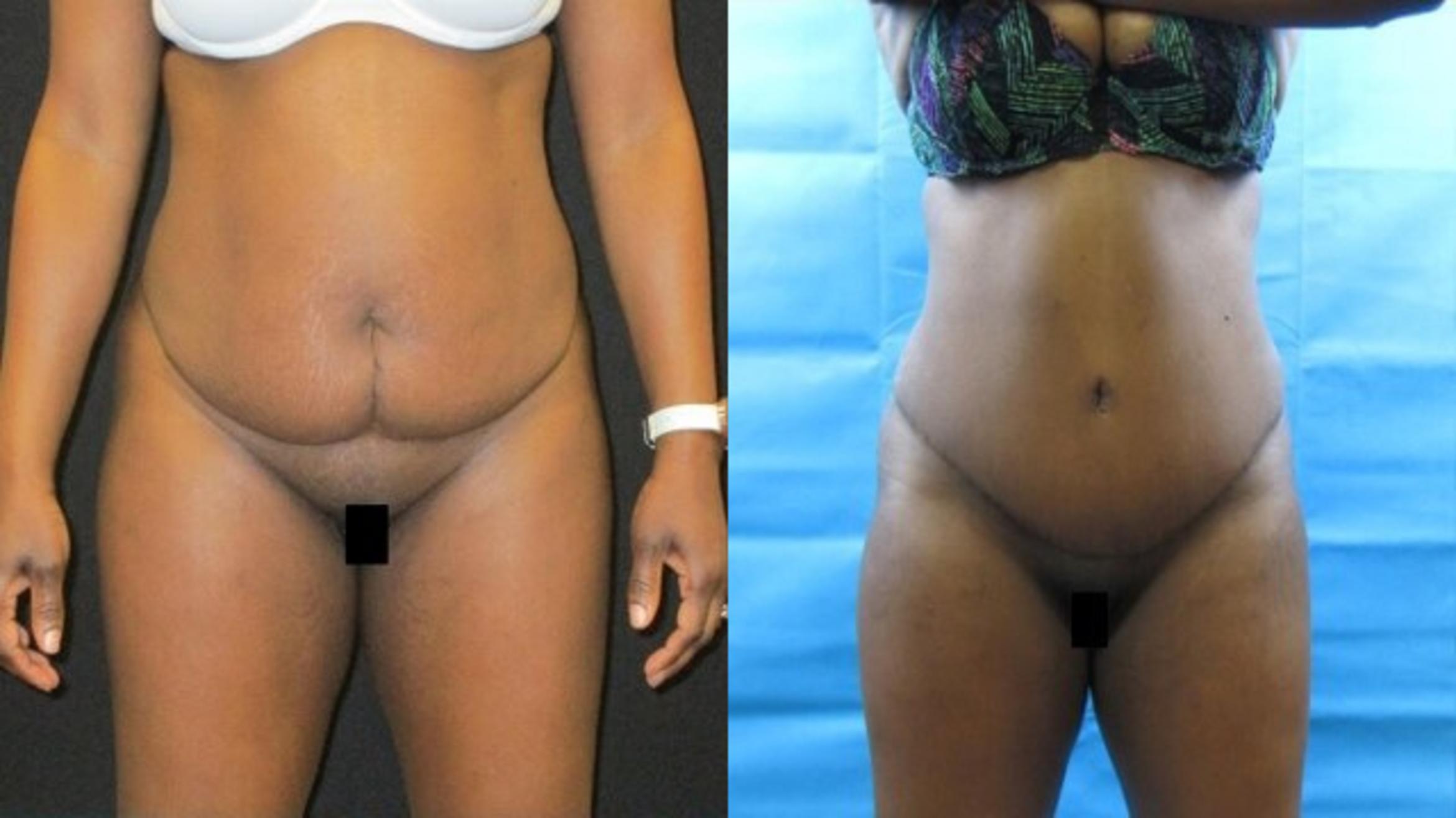 Before & After Tummy Tuck Case 129 View 1 View in Savannah, GA