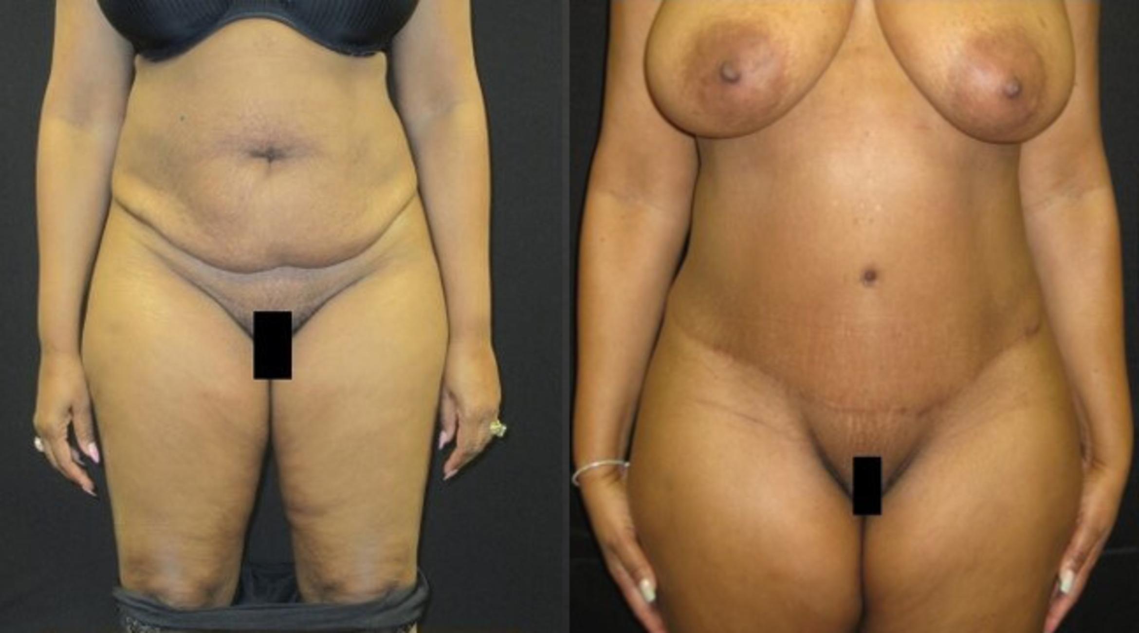 Before & After Tummy Tuck Case 130 View 1 View in Savannah, GA