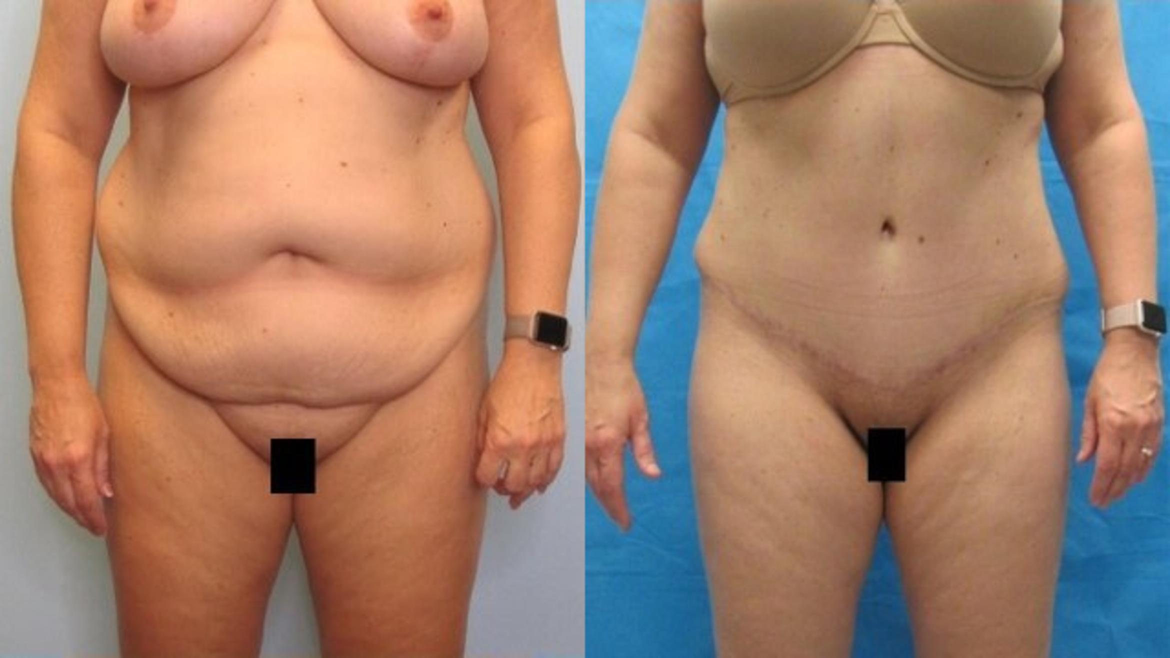 Before & After Tummy Tuck Case 132 View 1 View in Savannah, GA
