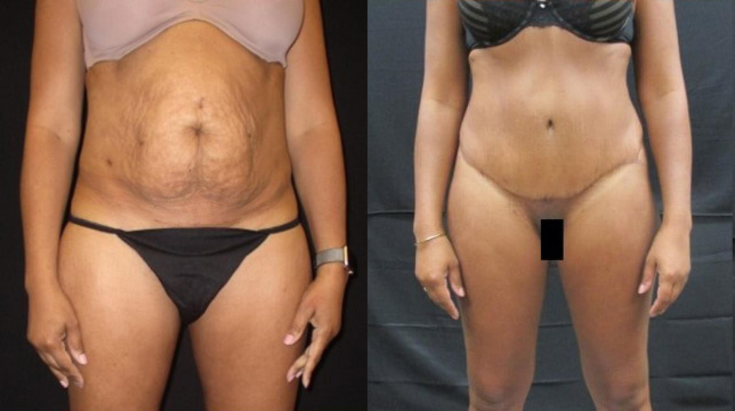 Before & After Tummy Tuck Case 134 View 1 View in Savannah, GA