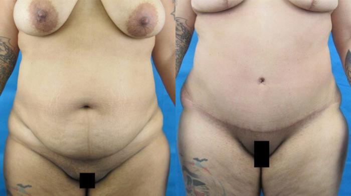 Before & After Tummy Tuck Case 135 View 1 View in Savannah, GA