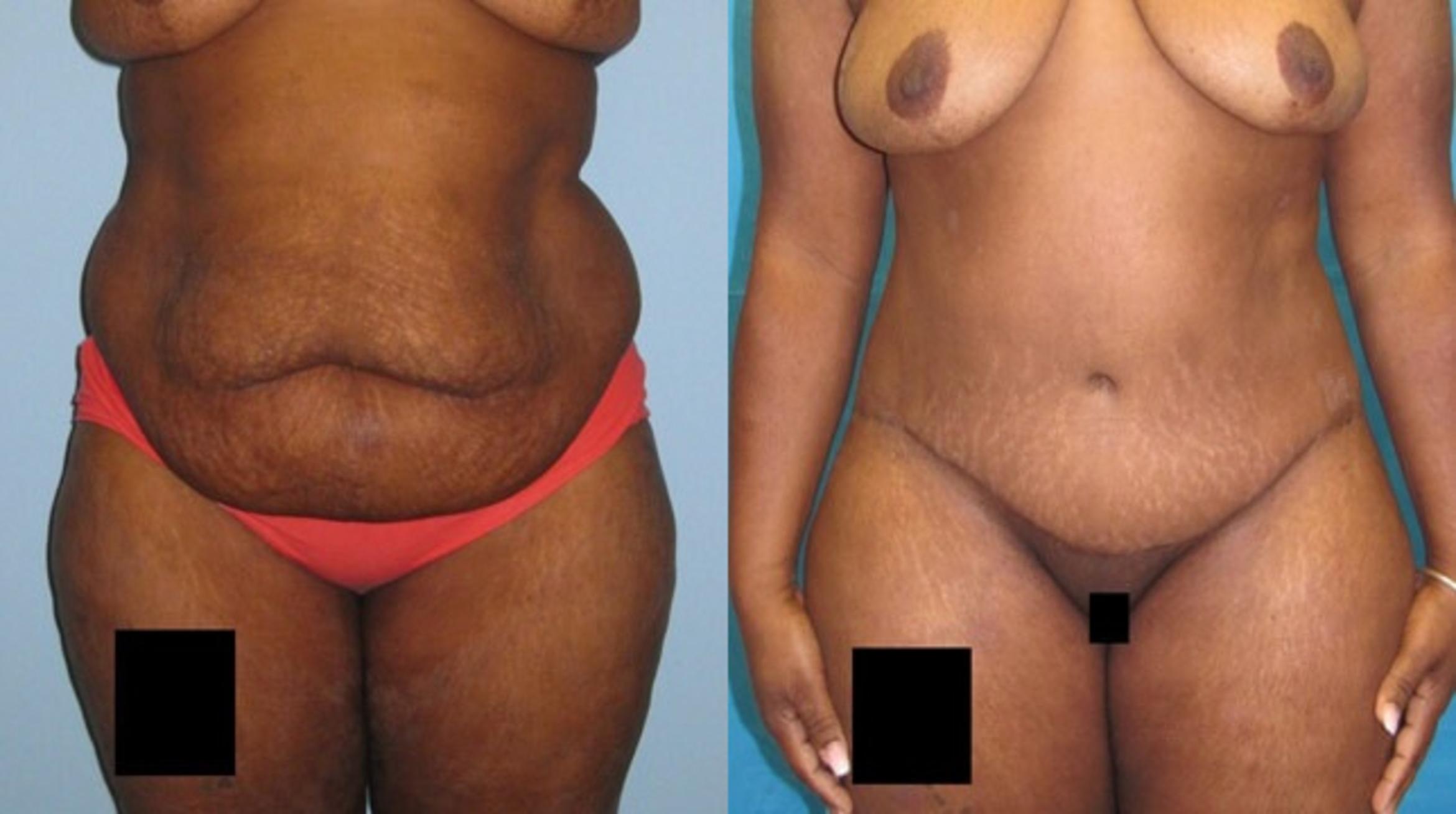 Before & After Tummy Tuck Case 136 View 1 View in Savannah, GA