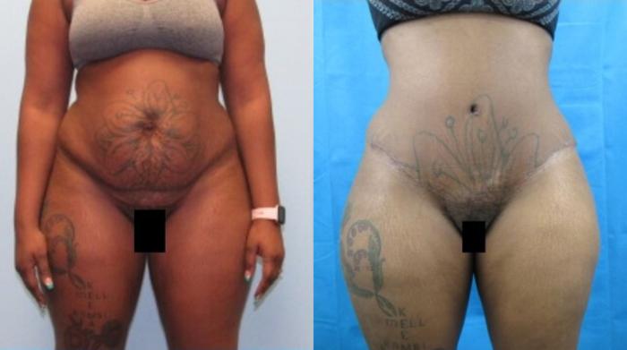 Before & After Tummy Tuck Case 138 View 1 View in Savannah, GA