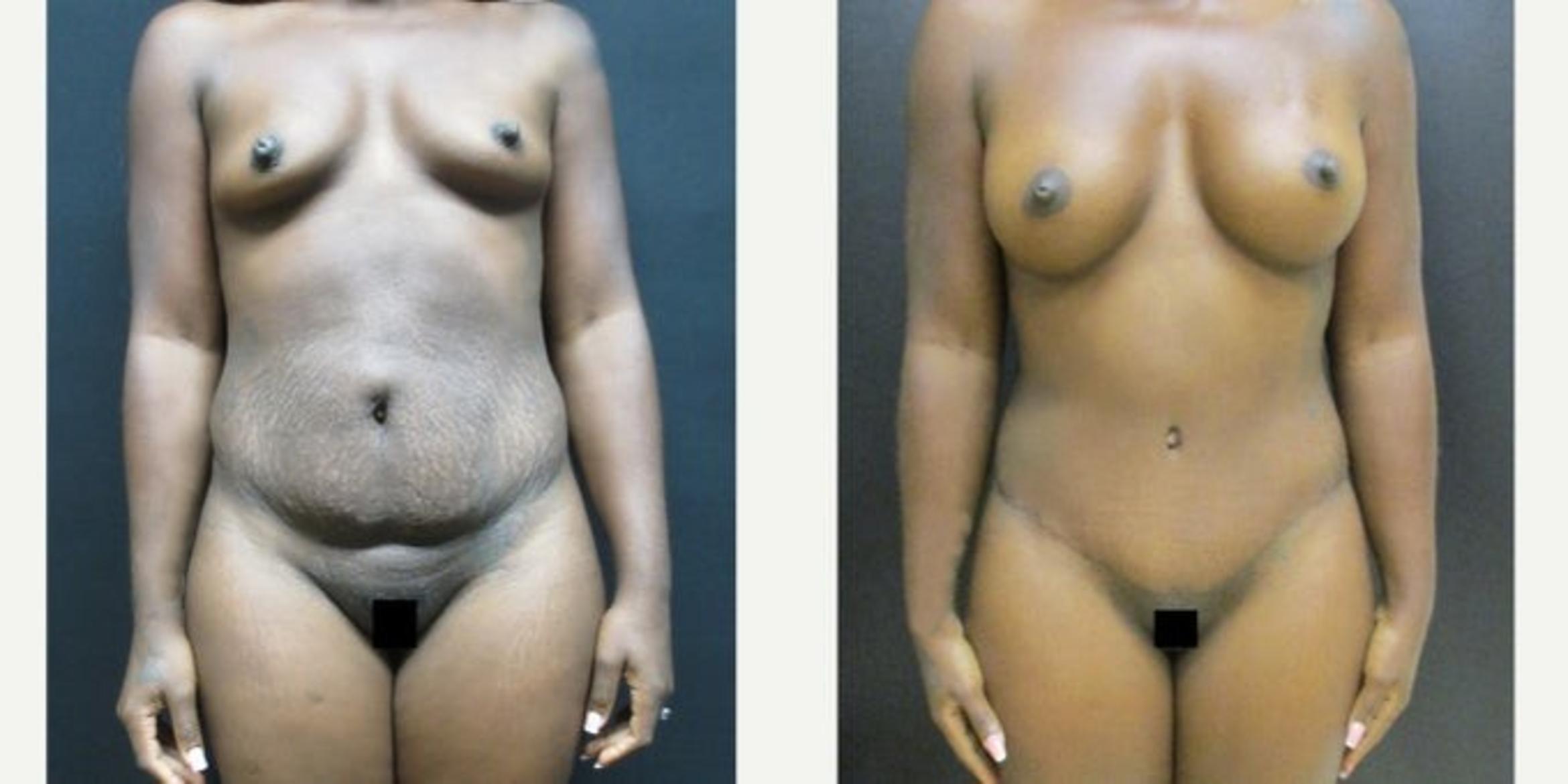 Before & After Tummy Tuck Case 139 View 1 View in Savannah, GA