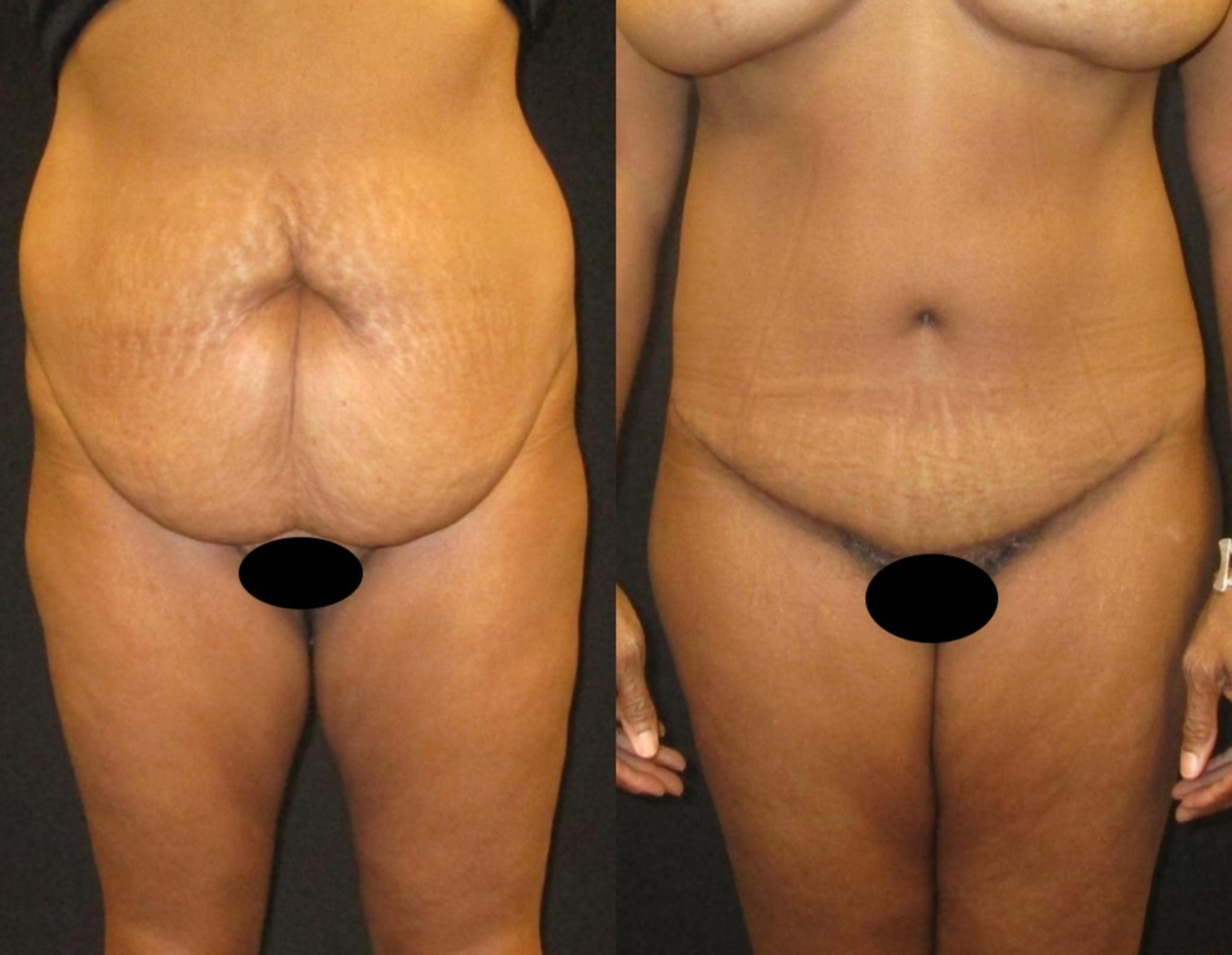 Before & After Tummy Tuck Case 140 View 1 View in Savannah, GA