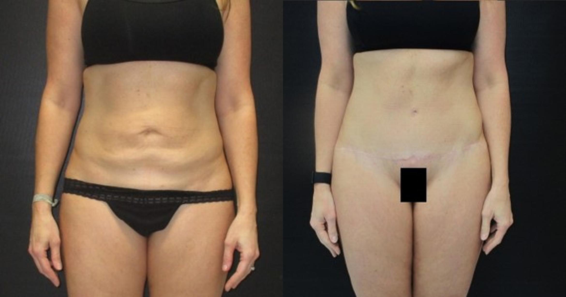 Before & After Tummy Tuck Case 141 View 1 View in Savannah, GA