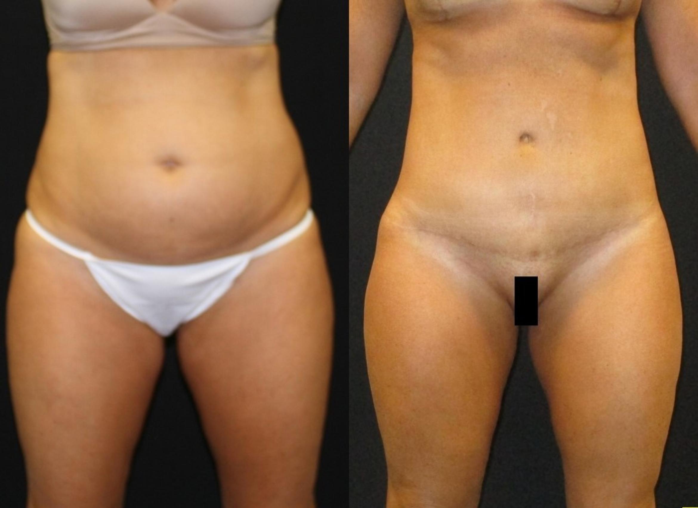 Before & After Tummy Tuck Case 144 View 1 View in Savannah, GA