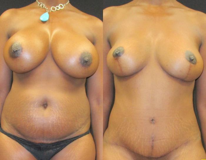 Before & After Tummy Tuck Case 145 View 1 View in Savannah, GA