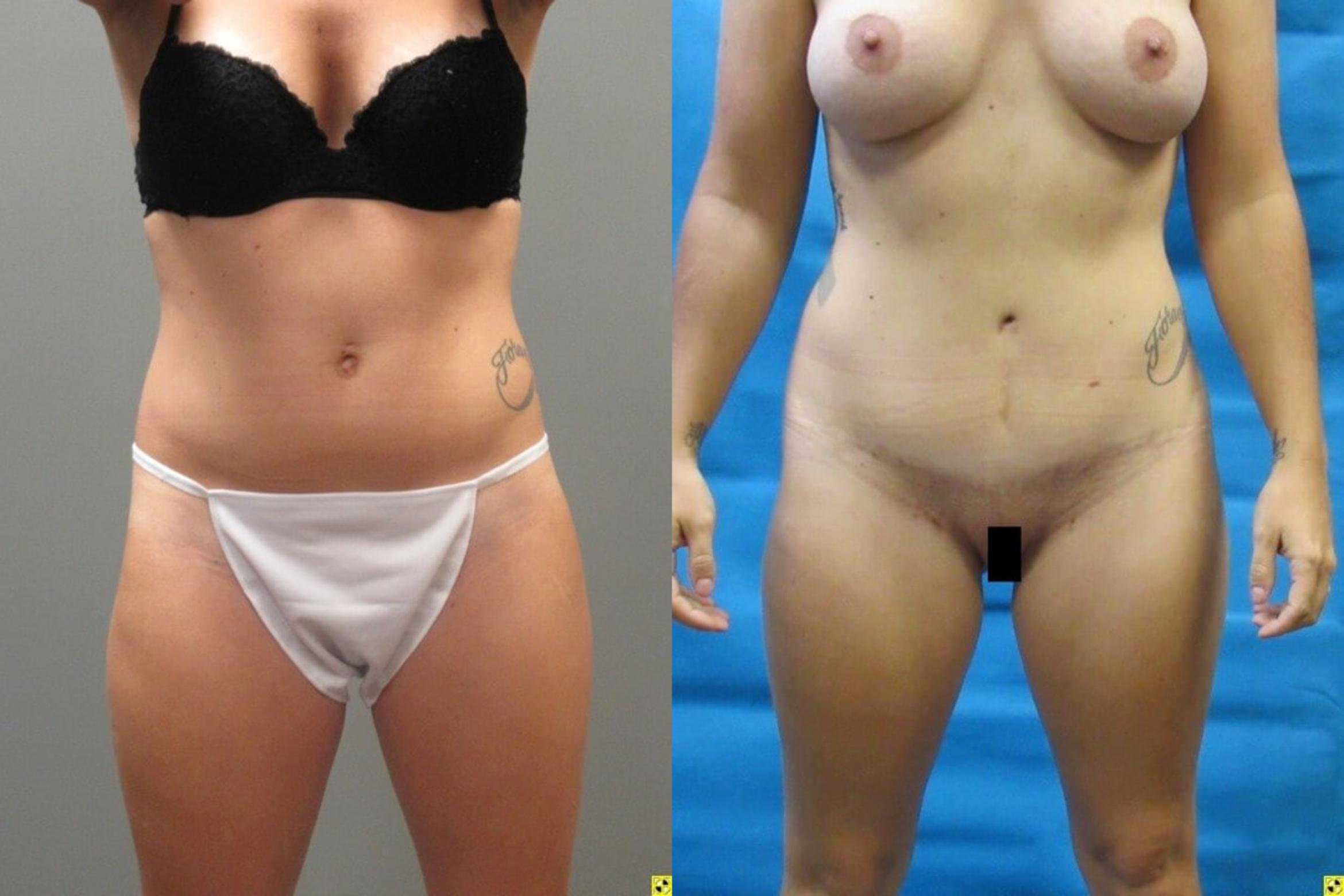 Before & After Tummy Tuck Case 146 View 1 View in Savannah, GA
