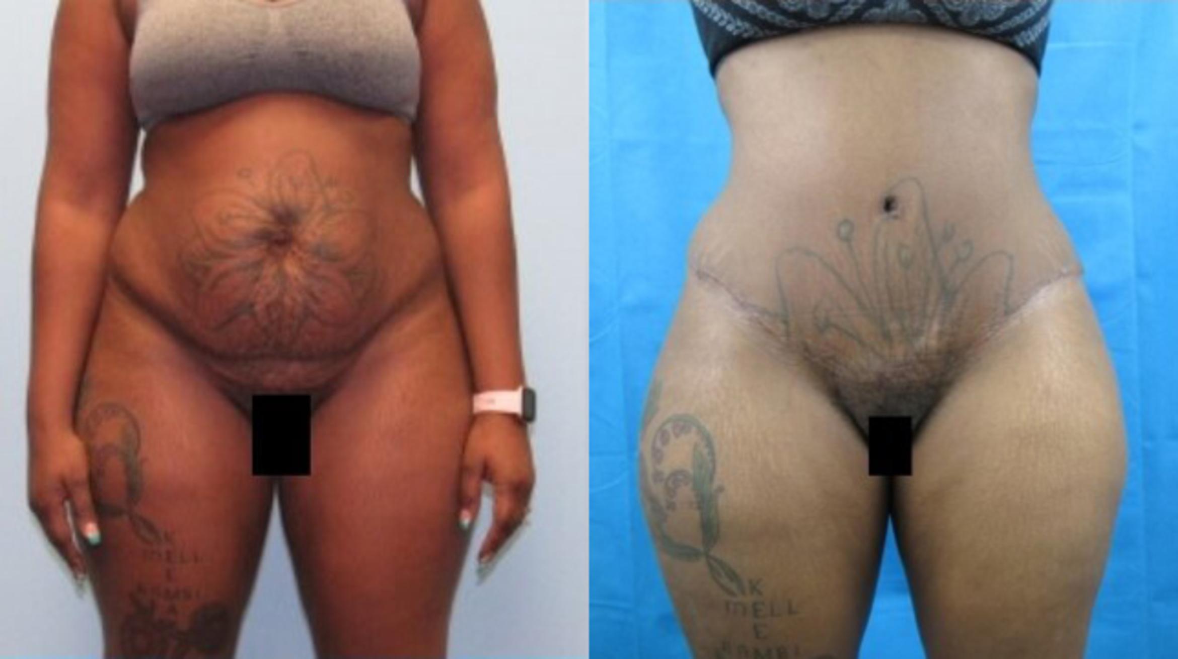 Before & After Tummy Tuck Case 150 View 1 View in Savannah, GA