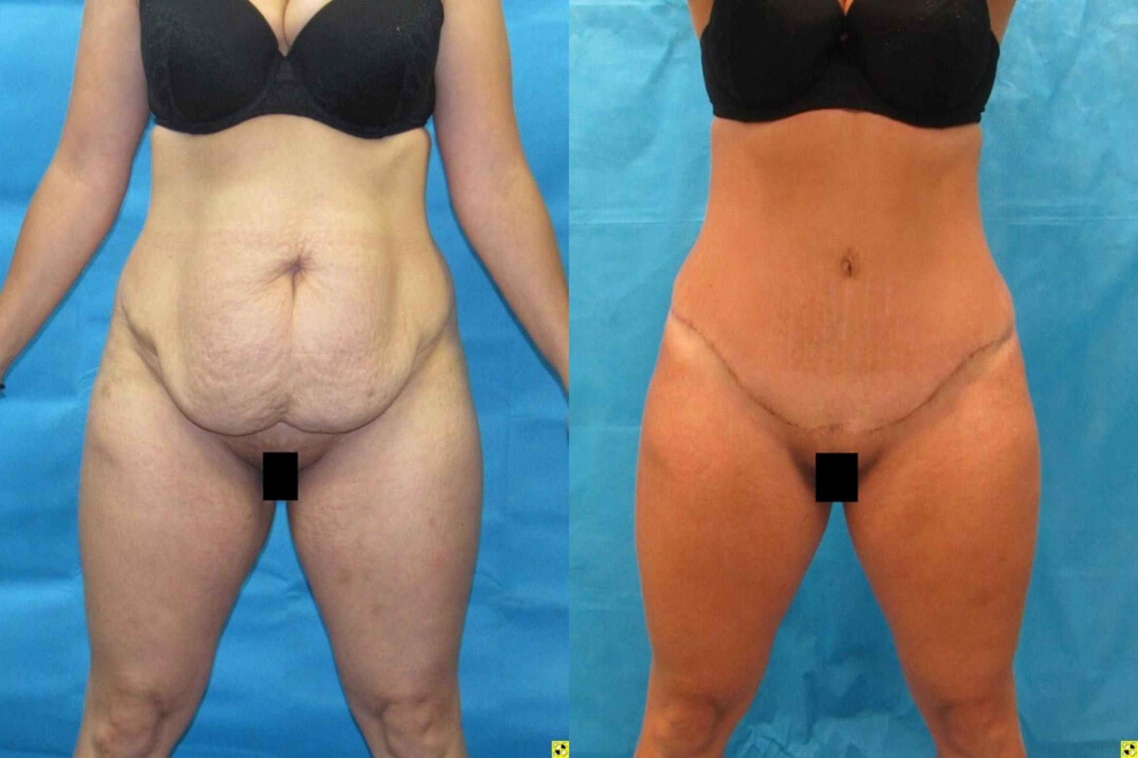 Before & After Tummy Tuck Case 151 View 1 View in Savannah, GA