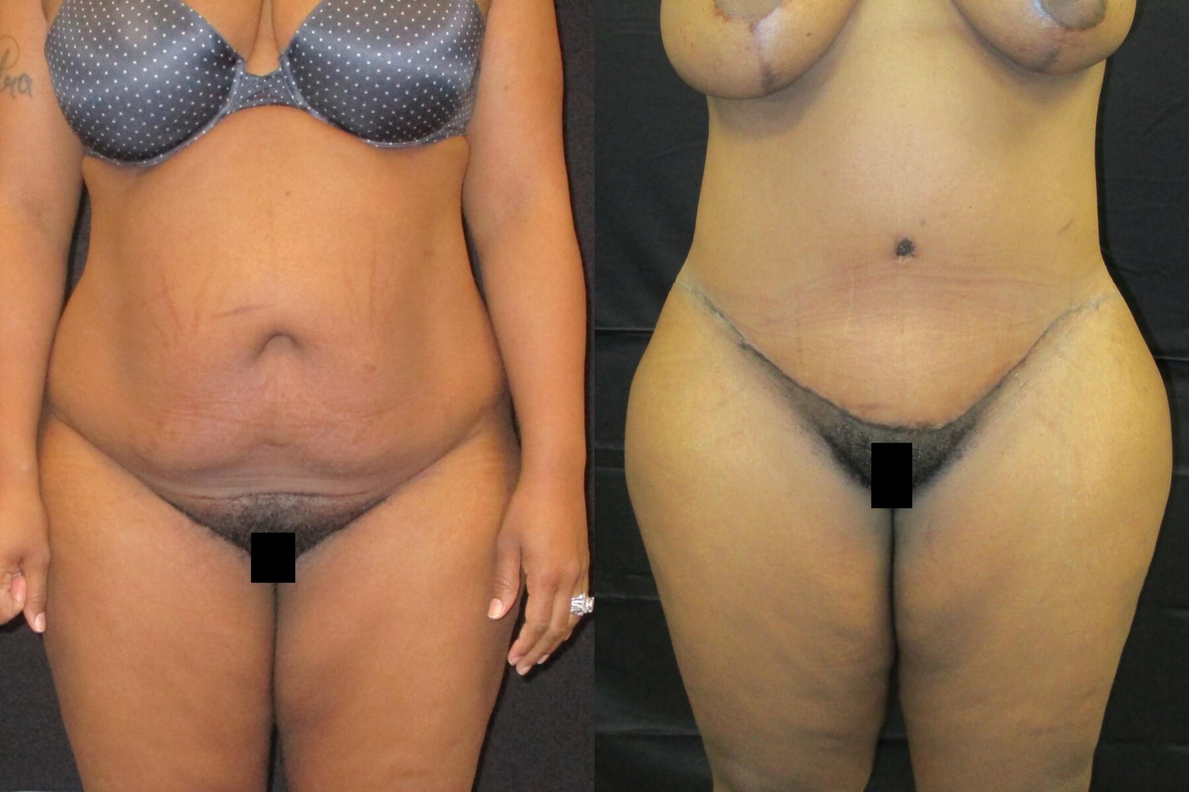 Before & After Tummy Tuck Case 59 View 1 View in Savannah, GA