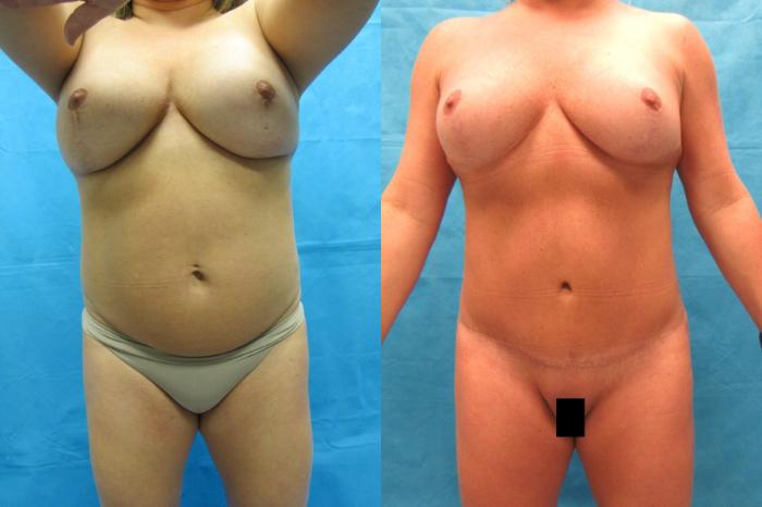 Before & After Tummy Tuck Case 64 View 1 View in Savannah, GA