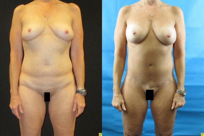 Before & After Tummy Tuck Case 65 View 1 View in Savannah, GA
