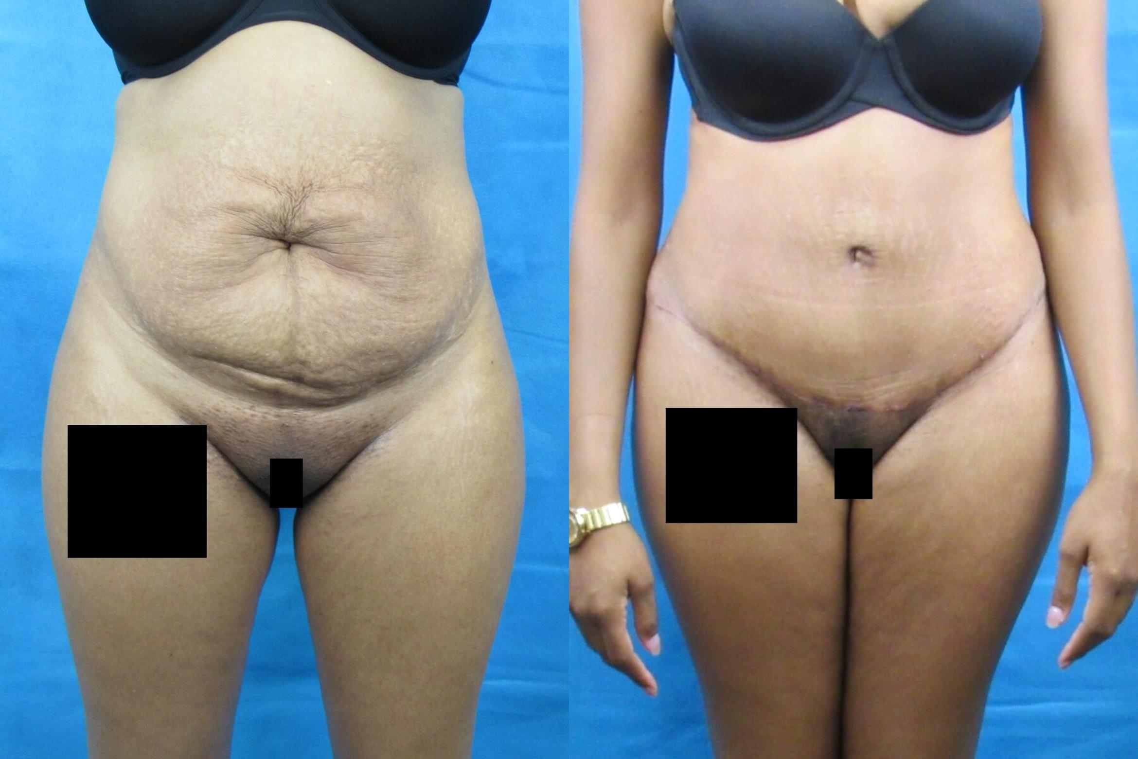 Before & After Tummy Tuck Case 98 View 1 View in Savannah, GA