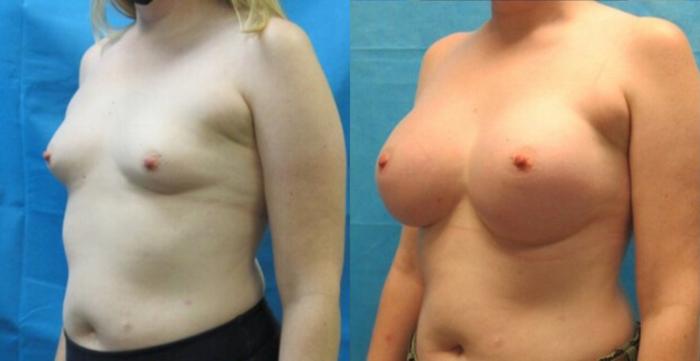 Before & After Breast Augmentation Case 1 View 2 View in Savannah, GA