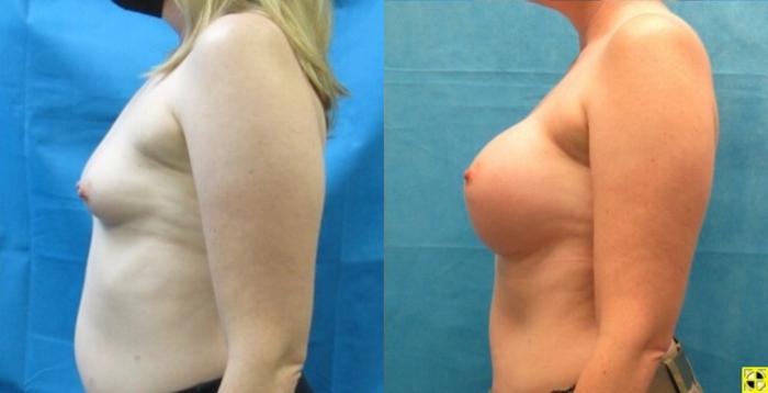 Before & After Breast Augmentation Case 1 View 3 View in Savannah, GA