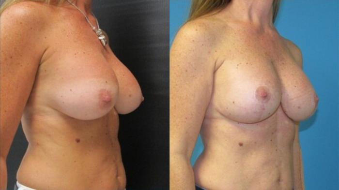 Before & After Breast Augmentation Case 12 View 2 View in Savannah, GA