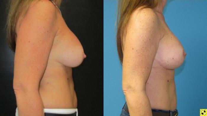 Before & After Breast Augmentation Case 12 View 3 View in Savannah, GA
