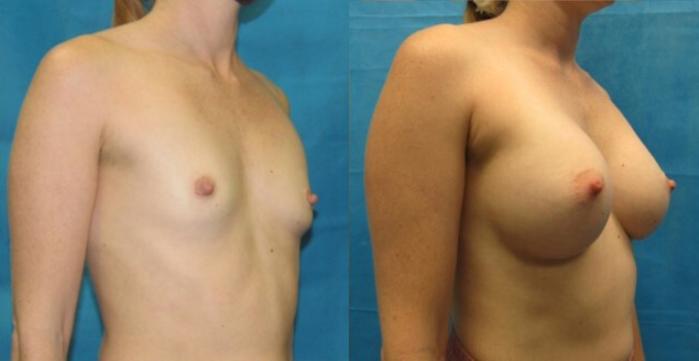 Before & After Breast Augmentation Case 13 View 2 View in Savannah, GA