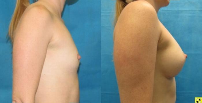 Before & After Breast Augmentation Case 13 View 3 View in Savannah, GA