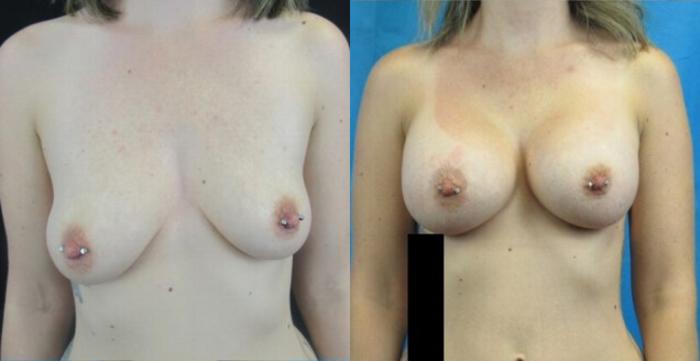 Before & After Breast Augmentation Case 14 View 1 View in Savannah, GA