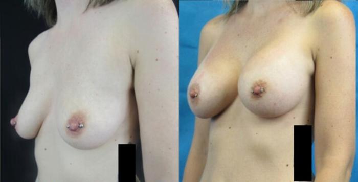 Before & After Breast Augmentation Case 14 View 2 View in Savannah, GA