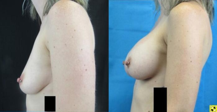 Before & After Breast Augmentation Case 14 View 3 View in Savannah, GA
