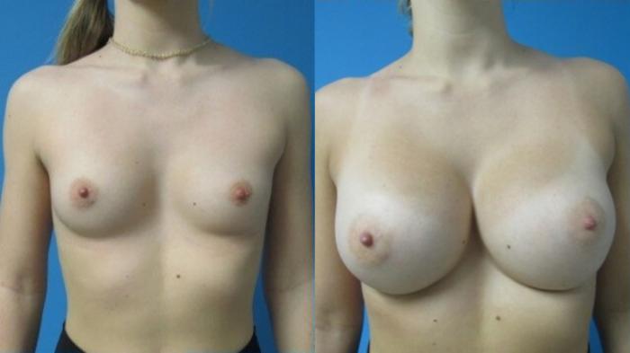 Before & After Breast Augmentation Case 15 View 1 View in Savannah, GA