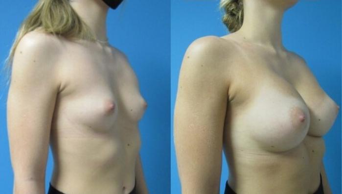 Before & After Breast Augmentation Case 15 View 2 View in Savannah, GA